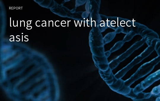 lung cancer with atelectasis